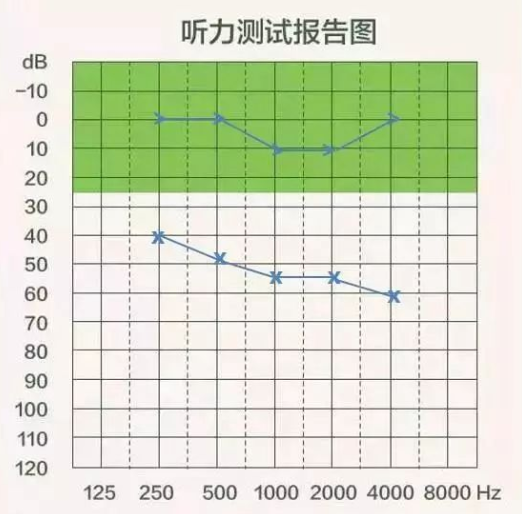 【听力科普】三分钟看懂纯音听力图(图11)